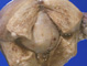 myoma
