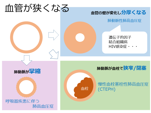 高い 原因 血圧