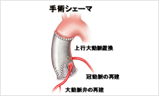 大動脈疾患