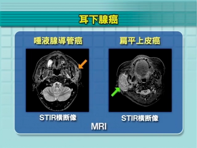頸部腫瘤の診断法｜千葉大学大学院医学研究院 耳鼻咽喉科・頭頸