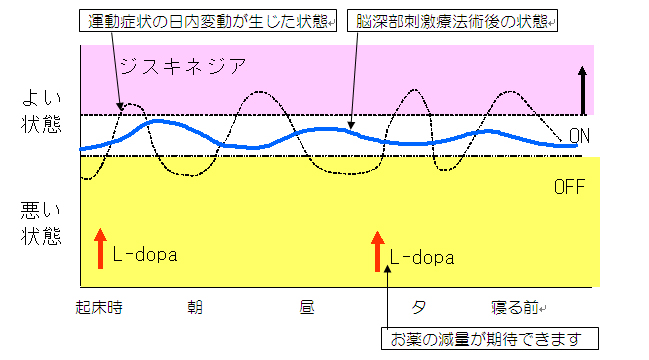 Dbs治療 脳深部刺激療法 定位的脳手術 パーキンソン病 振戦 ジストニア 倉敷ニューロモデュレーションセンター