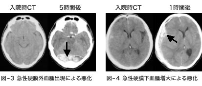 重症頭部外傷 千葉大学大学院医学研究院 脳神経外科学