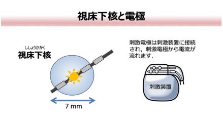 2_視床下核と電極.jpg