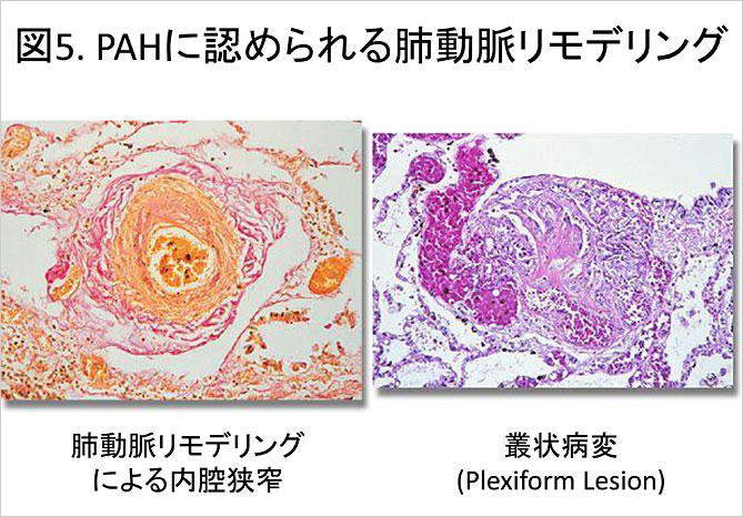 特発性肺動脈性肺高血圧症 遺伝性肺動脈性 千葉大学大学院医学研究院 呼吸器内科学